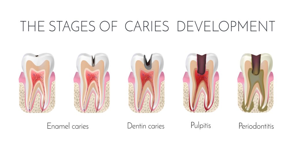 Root Canal Treatment in Dentistry - Root Canals ...