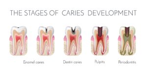 Diagram showing the various stages of tooth decay and cavity development leading to pulpitis