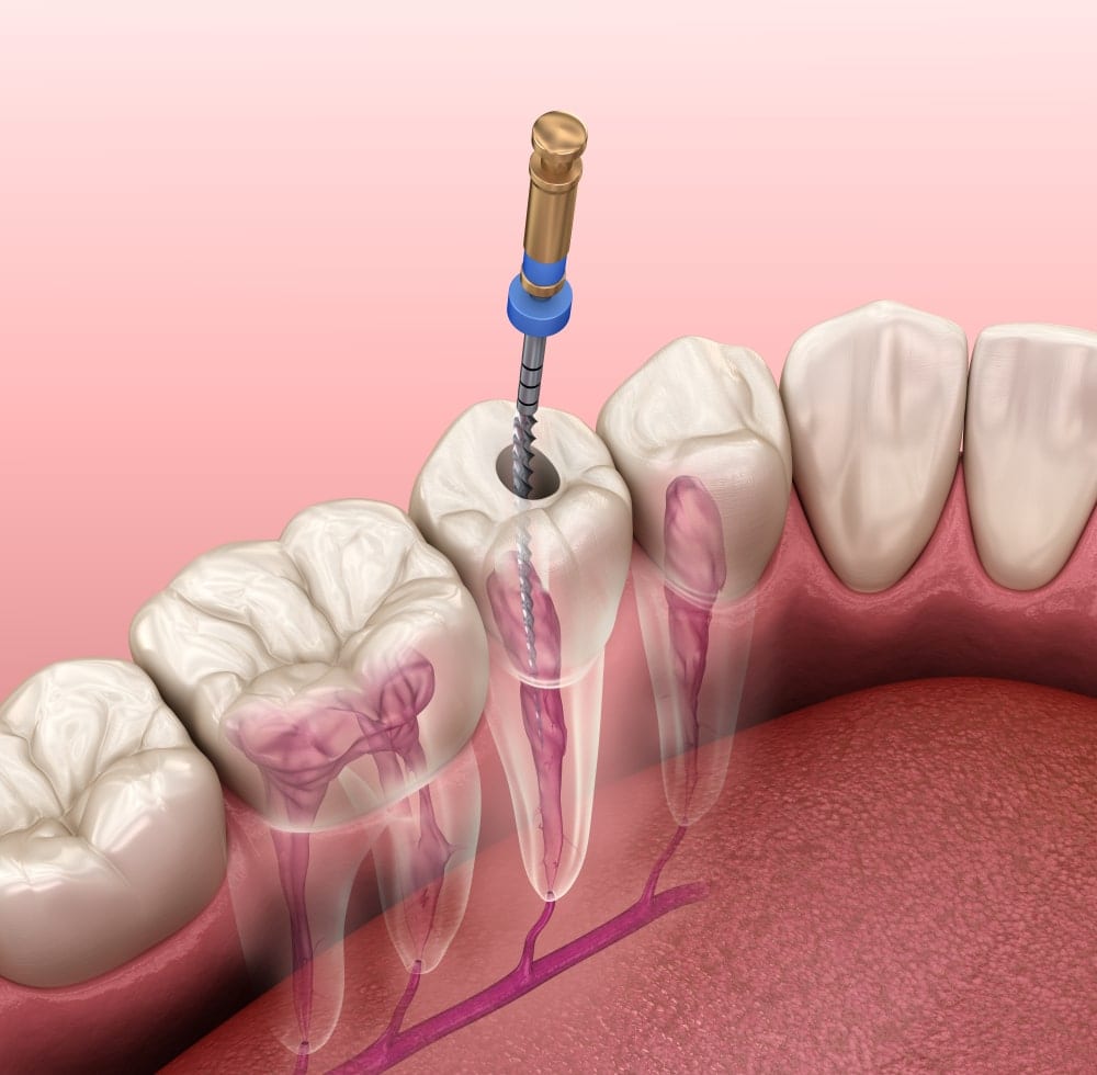 Dental file being used during a root canal
