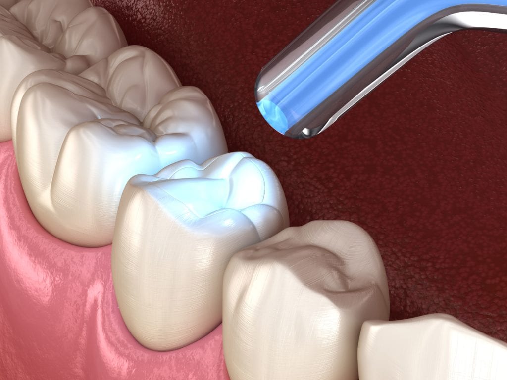The Many Benefits Of Composite Resin Danforthdentalsolutions Ca