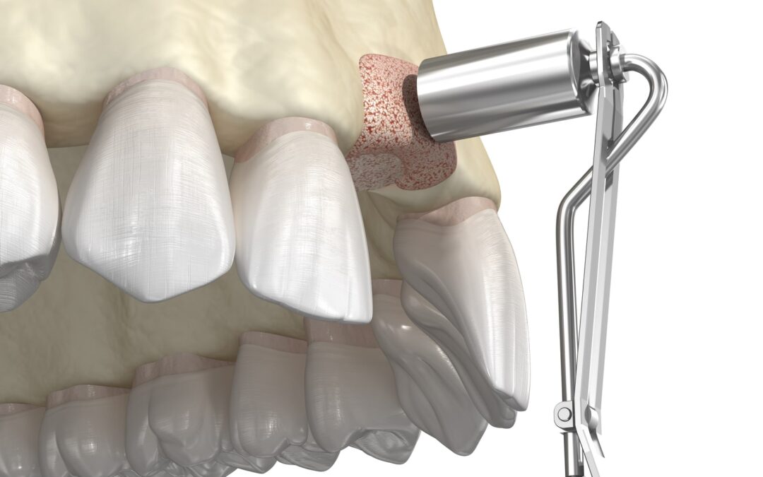 Why Bone Grafts In Dentistry Are Necessary