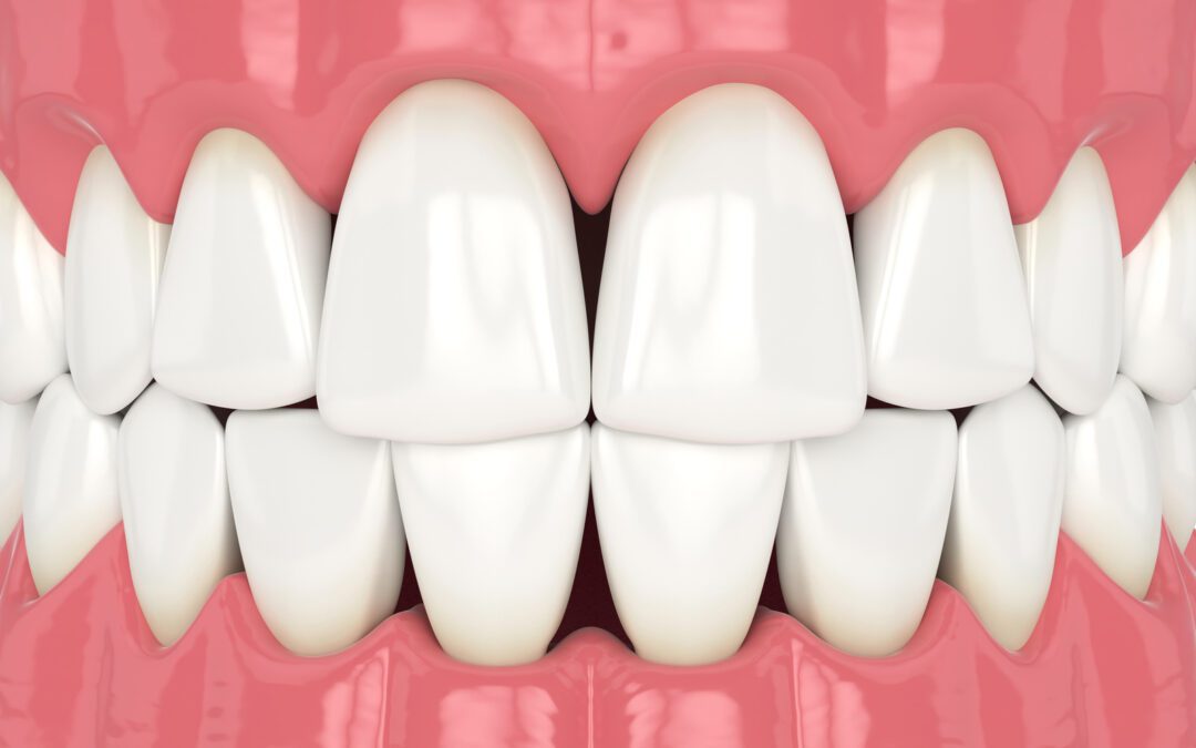 Tooth Stress and Covid-19: The Rise of Bruxism and Fractures