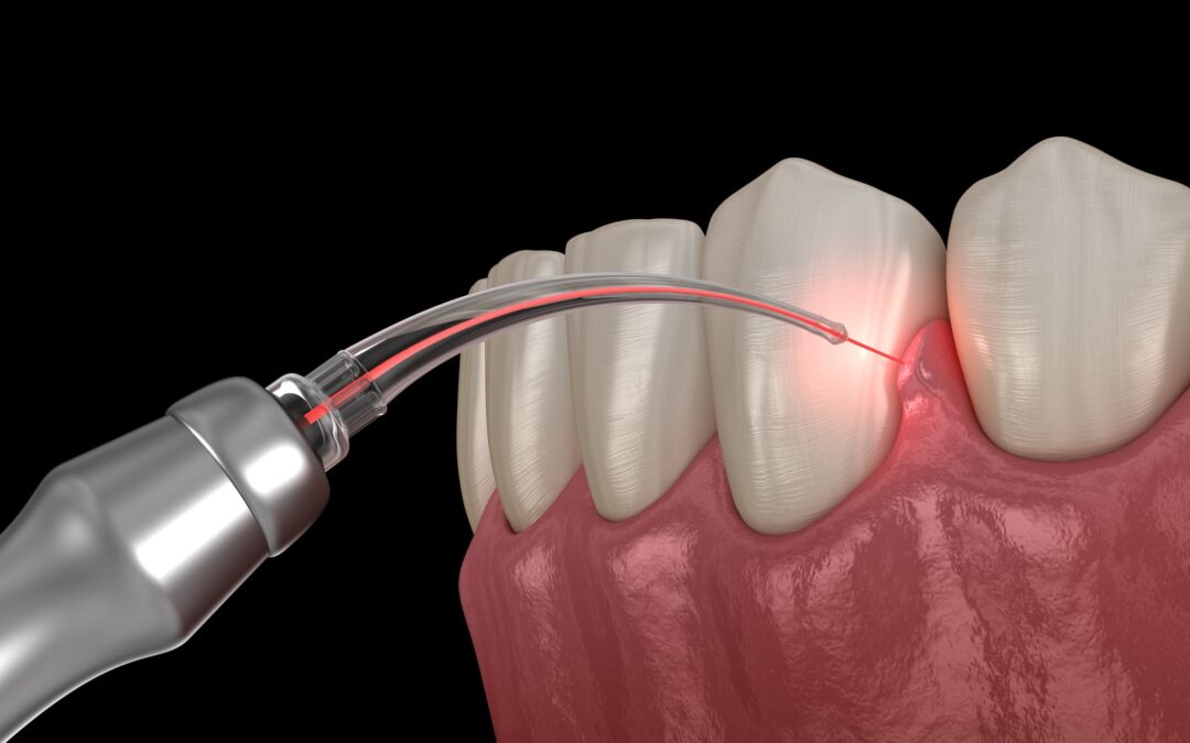 How Dental Anxiety Sufferers Benefit From Laser Dentistry